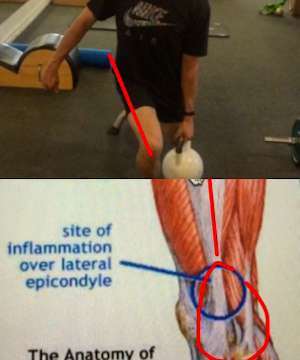 The dreaded ITB syndrome